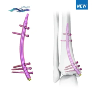 Distal Tibial Intramedullary Nail DTN titanium implant for orthopedic trauma fracture fixation