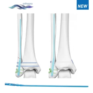 Expert Fibular Intramedullary Nail System for Distal Fibula Fractures