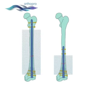 OrthoPro Femoral Intertan Nail titanium system for hip and femur fracture fixation
