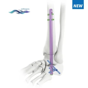 Hindfoot Fusion Ankle Nail titanium orthopedic implant for TTC arthrodesis and Charcot foot surgery