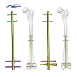 OrthoPro Distal Femur Intramedullary Nail (DFN) kit for retrograde surgery