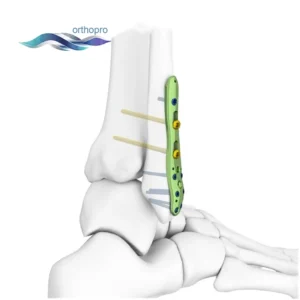 OrthoPro Anatomical Distal Fibular Locking Plate for lateral malleolus ankle fracture surgery