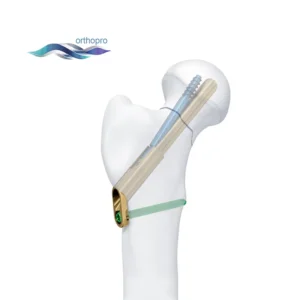 Titanium FNS Femoral Neck System for hip fracture surgery - OrthoPro