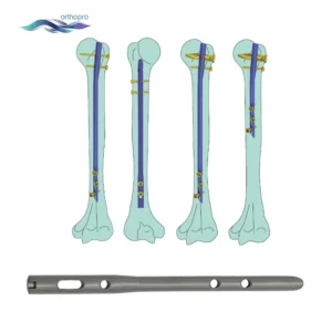 OrthoPro Humeral Intramedullary Nail Blade Type for proximal fracture fixation