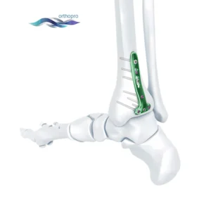 Titanium VA Distal Tibia Locking T Plate for orthopedic trauma surgery - OrthoPro
