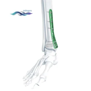 OrthoPro Variable Angle VA Distal Medial Tibia Locking Plate for pilon fracture surgery