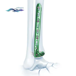 OrthoPro Variable Angle VA Distal Lateral Tibia Locking Plate for anterolateral pilon fracture fixation