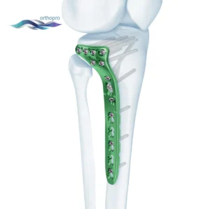 OrthoPro Variable Angle VA Proximal Tibia Locking Plate titanium implant for lateral plateau fracture fixation