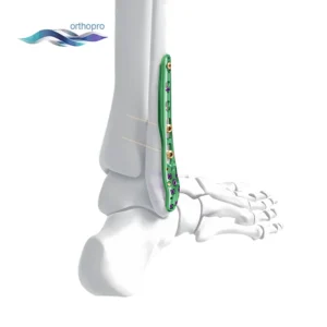 Distal Lateral Fibular Locking Plate titanium orthopedic implant for ankle fracture fixation by OrthoPro